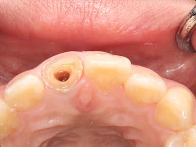 ポスト形成された前歯根面